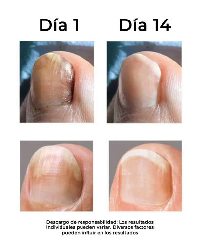 OedoNails™ Extracto para el cuidado de las uñas con veneno de abeja | ¡De suave a hermoso en sólo 14 días!